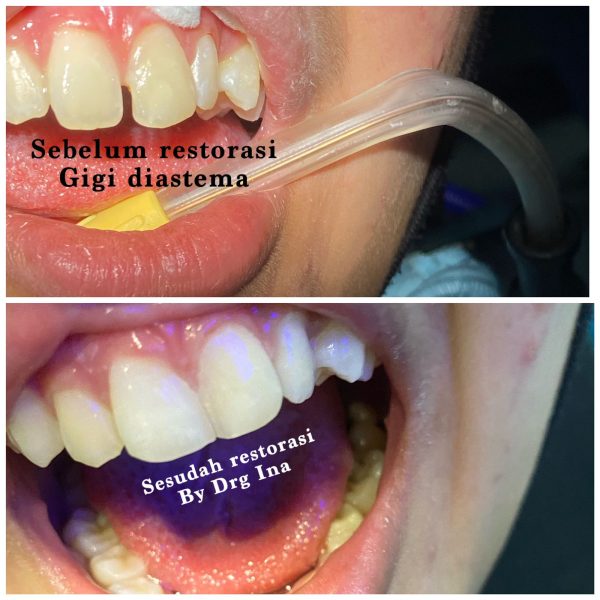 Ilustrasi : Perawatan kesehatan gigi dan mulut.Foto : dok. drg Ina Asmari Syawalina